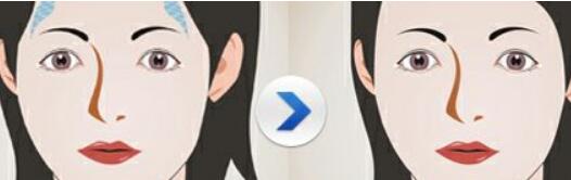 廣州微晶去痘疤費(fèi)用正式發(fā)布(廣州高尚醫(yī)學(xué)美容門診部微晶去痘疤參考價(jià)：4158元)