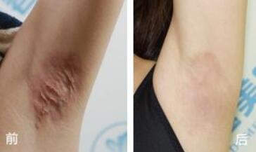 烏魯木齊點陣激光祛魚尾紋收費價目表一覽(烏魯木齊里美醫(yī)療美容整形醫(yī)院點陣激光祛魚尾紋參考價：6868元)