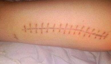 杭州水光針去除雀斑報價手術(shù)價格(杭州蕭山區(qū)中醫(yī)院整形科水光針去除雀斑參考價：4762元)