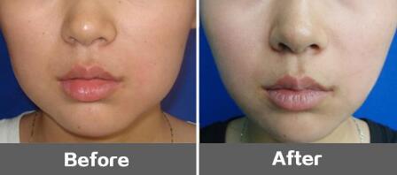 太原皮秒去頸部皺紋價格表2023新版(太原華晉醫(yī)院醫(yī)療美容中心皮秒去頸部皺紋參考價：6652元)