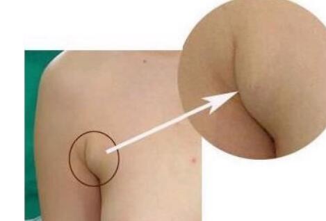 南昌胸部下垂手術(shù)矯正手術(shù)費(fèi)用詳細(xì)一覽(南昌一附醫(yī)院整形科胸部下垂手術(shù)矯正參考價(jià)：6152元)