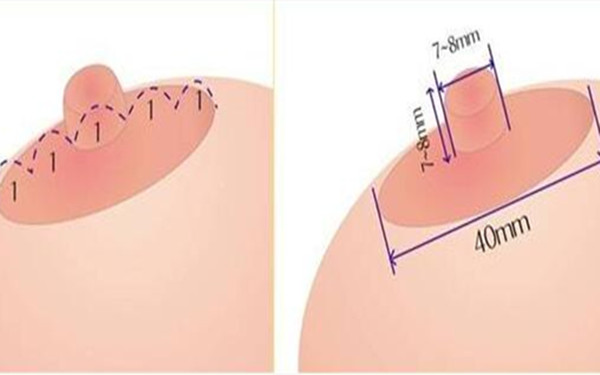 長沙超肋鼻整形手術(shù)價(jià)格表對(duì)比(湘美匯長沙解西醫(yī)療美容醫(yī)院超肋鼻整形手術(shù)參考價(jià)：6003元)
