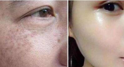 杭州熱瑪吉祛眉間紋的價錢公開一覽(杭州浙美醫(yī)療美容門診部熱瑪吉祛眉間紋參考價：3847元)