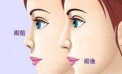 南京磨骨瘦臉整形大概要多少價格(南京瑞鑫燒傷?？漆t(yī)院磨骨瘦臉整形參考價：5676元)