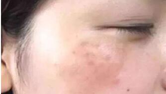 武漢微切口除皺紋一次應該要多少錢(武漢光澤皇后整形醫(yī)院微切口除皺紋參考價：4558元)