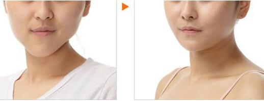 吉林美雕祛痘印價格表明細全面更新(吉林馮淑嫻醫(yī)療美容診所美雕祛痘印參考價:4160元)