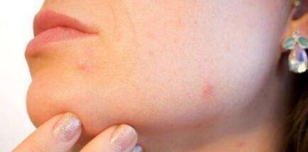 河南生長紋去除法價格