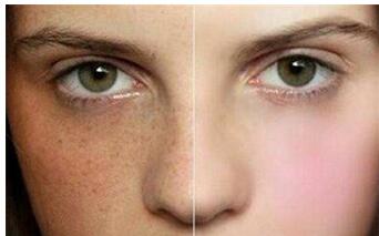 廊坊唇腭裂畸形鼻修復價目表收費透明一覽(廊坊一美佳整形醫(yī)療美容醫(yī)院唇腭裂畸形鼻修復參考價：3213元)