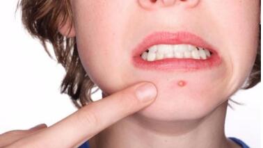 中山臉部胎記治療價(jià)格