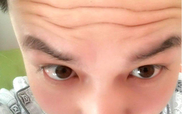 呼和浩特祛咖啡斑大概要多少錢(呼和浩特京華醫(yī)療整形美容診所祛咖啡斑參考價(jià)：3642元)