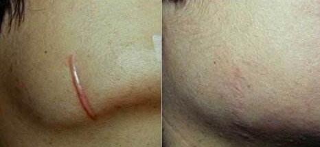 北京微針美塑面部除皺價(jià)格表2023版公開，速覽(北京四惠中醫(yī)院整形科微針美塑面部除皺參考價(jià)：5588元)