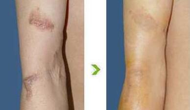 綿陽(yáng)電波拉皮去除法令紋價(jià)格表整理(綿陽(yáng)熙芝匠心醫(yī)療美容診所電波拉皮去除法令紋參考價(jià)：6895元)