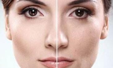 蘇州激光祛除面部皺紋大約價位是多少(蘇州附二院整形美容科激光祛除面部皺紋參考價：5829元)