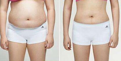 東莞魚尾紋射頻去除的價格需要多少錢(東莞安緹薇醫(yī)療美容魚尾紋射頻去除參考價：3455元)