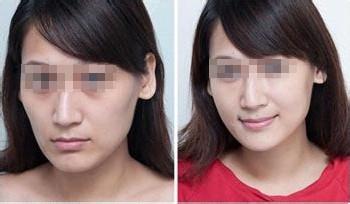 長(zhǎng)沙面部五官雕塑整形價(jià)格正式發(fā)布(長(zhǎng)沙星美域醫(yī)療美容醫(yī)院面部五官雕塑參考價(jià)：6014元)