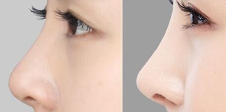 中山眼部皺紋手術價格表費用2023新版展示(第一中山大學孫逸仙紀念醫(yī)院眼部皺紋手術參考價：5758元)