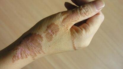 江蘇激光祛痘印手術(shù)手術(shù)價格會不會很貴(江蘇南京美萊醫(yī)療美容醫(yī)院激光祛痘印手術(shù)參考價：5479元)