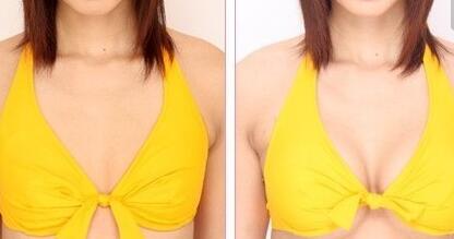 福州射頻妊娠紋價(jià)格表一覽表(福州醫(yī)科大學(xué)附屬福州第一醫(yī)院整形科射頻妊娠紋參考價(jià)：5582元)