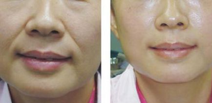 杭州針雕去妊娠紋大概需要手術(shù)價錢多少(杭州卓儷薈整形醫(yī)療美容醫(yī)院針雕去妊娠紋參考價：5791元)