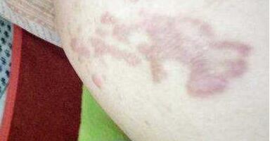 杭州膠原蛋白填充木偶紋2023價(jià)目表全面更新(杭州嬌妍玥尚醫(yī)療美容診所膠原蛋白填充木偶紋參考價(jià)：6485元)