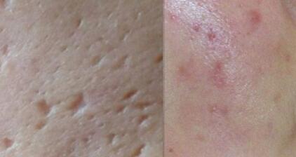 株洲消除胸部妊娠紋價(jià)格