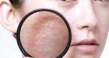 陜西臉部凹陷疤痕整形價格表上線(陜西醫(yī)科大學(xué)友誼整形醫(yī)院臉部凹陷疤痕參考價：3605元)