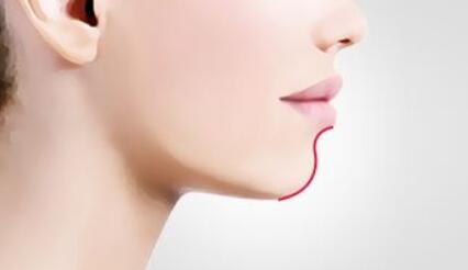 漳州臥蠶玻尿酸費用需要花多少(漳州175醫(yī)院整形美容科臥蠶玻尿酸參考價：3235元)