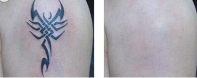 寧波下巴打溶脂針費用圖表查詢(武警寧波113醫(yī)院整形美容醫(yī)院下巴打溶脂針參考價：6541元)