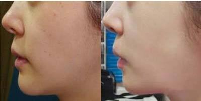 寧波飛秒激光去黑痣的費(fèi)用大概要多少錢一次(寧波江北韓美醫(yī)療美容門診部飛秒激光去黑痣?yún)⒖純r(jià)：5537元)