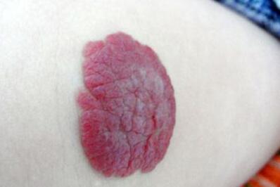 廣州埋線割雙眼皮價(jià)格表公開一覽(廣州博研醫(yī)療美容門診部埋線割雙眼皮參考價(jià)：5546元)