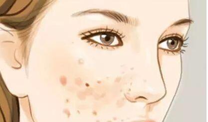 鎮(zhèn)江果酸換膚去黑頭可能要多少錢(鎮(zhèn)江歌美醫(yī)學美容診所果酸換膚去黑頭參考價：6465元)