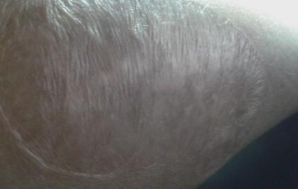 南京豐耳垂術(shù)治療價格剖析(南京醫(yī)科大學(xué)第二附屬醫(yī)院整形美容科豐耳垂術(shù)參考價：6005元)