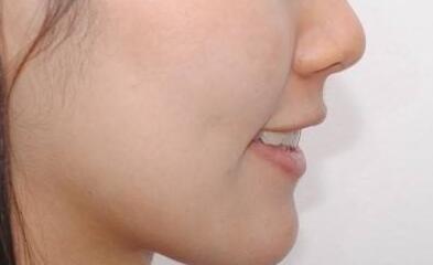 淄博熱瑪吉填充手術(shù)價(jià)格詳細(xì)一覽(淄博第四人民醫(yī)院整形科熱瑪吉填充參考價(jià)：3955元)