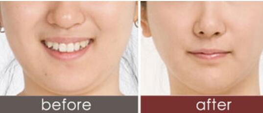 珠海共振吸脂減肥瘦手臂價格