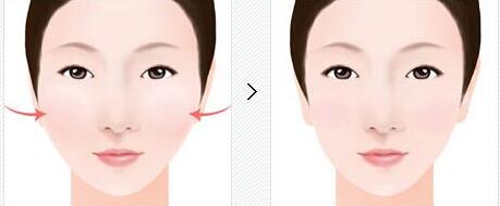 無錫下巴玻尿酸填充收費價目圖表剖析(無錫曼陀羅華美整形美容醫(yī)院下巴玻尿酸填充參考價：5228元)