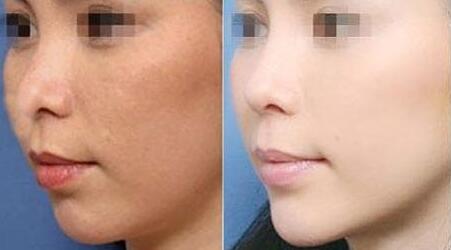 北京臀部電動(dòng)負(fù)壓吸脂治療費(fèi)用一覽表剖析(北京歐陽(yáng)整形醫(yī)院臀部電動(dòng)負(fù)壓吸脂參考價(jià)：5580元)