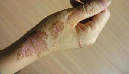 武漢木偶紋激光去除價目表全新一覽(武漢中愛整形醫(yī)院木偶紋激光去除參考價：6360元)