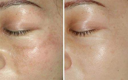 南京鼻孔開大術(shù)手術(shù)費(fèi)用驚喜爆出(南京寰鍶醫(yī)療美容診所鼻孔開大術(shù)參考價(jià)：4160元)