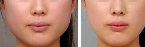 東莞微整形眉間紋費(fèi)用價(jià)格(東莞慢性病防治醫(yī)院醫(yī)學(xué)美容科微整形眉間紋參考價(jià)：5687元)