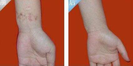 鞍山共振吸脂減肥瘦大腿大致市場(chǎng)價(jià)格(馬鞍山婦幼保健院整形科共振吸脂減肥瘦大腿參考價(jià)：6554元)