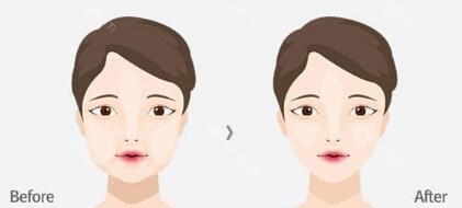 成都光子嫩膚改善皮膚粗糙全新整形價格表(成都潤玉之光醫(yī)療美容醫(yī)院光子嫩膚改善皮膚粗糙參考價：3401元)