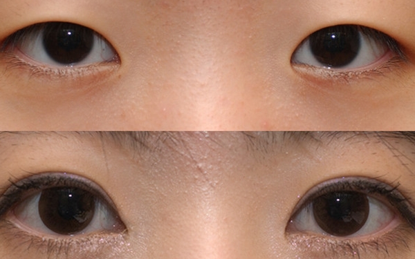 南京膠原蛋白填充豐鼻唇溝價格