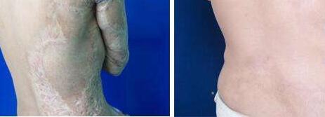 成都注射祛除面部皺紋整形優(yōu)惠價格全面更新(成都銅雀臺醫(yī)學美容醫(yī)院注射祛除面部皺紋參考價：3907元)