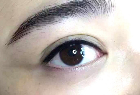 長(zhǎng)沙線雕提升眉間紋價(jià)格