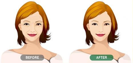 泰州自體脂肪填充鼻唇溝價格