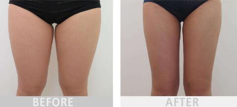 杭州頸部皺紋祛除手術(shù)費用上線(杭州悅可醫(yī)療美容醫(yī)院頸部皺紋祛除參考價：5271元)