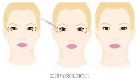 合肥韓式動感隆胸整形費(fèi)用上線(合肥美奧醫(yī)療美容診所韓式動感隆胸參考價：3079元)