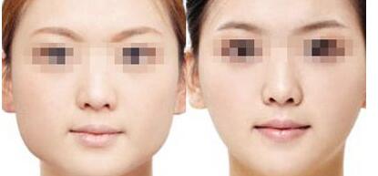 成都水光針去抬頭紋價格表在線免費公布(成都和諧醫(yī)療美容門診水光針去抬頭紋參考價:6754元)