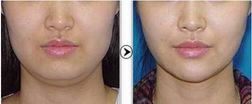 寧夏射頻微針去眼底紋的費(fèi)用一般需要多少錢啊(寧夏田永成整形醫(yī)院射頻微針去眼底紋參考價(jià)：4407元)