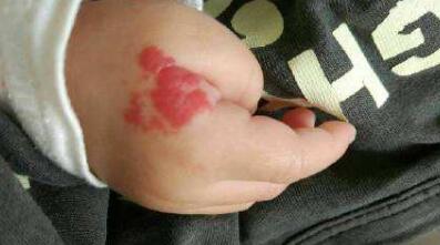 福州提拉印第安紋具體市場(chǎng)價(jià)格(福州伽禾伽美整形美容醫(yī)院提拉印第安紋參考價(jià)：5486元)